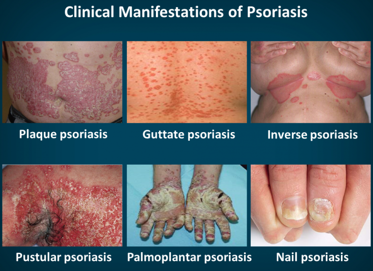 Diagnosis Psoriasis Thrive 