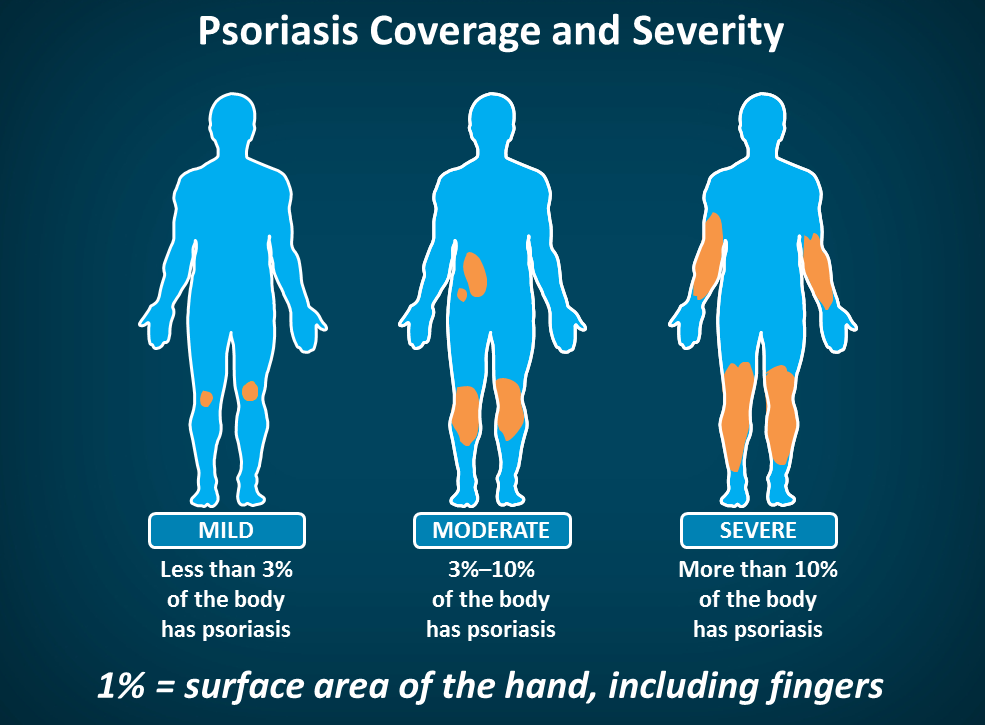 psoriasis classification mild moderate severe